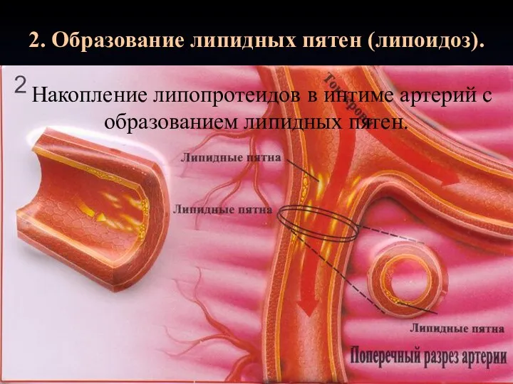 2. Образование липидных пятен (липоидоз). Накопление липопротеидов в интиме артерий с образованием липидных пятен.
