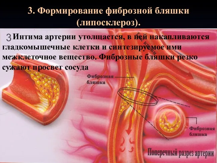 3. Формирование фиброзной бляшки (липосклероз). Интима артерии утолщается, в ней накапливаются гладкомышечные клетки