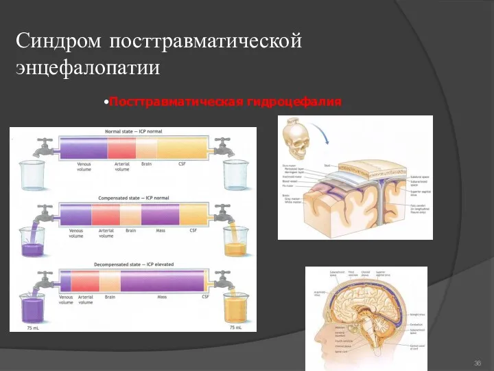 Синдром посттравматической энцефалопатии •Посттравматическая гидроцефалия