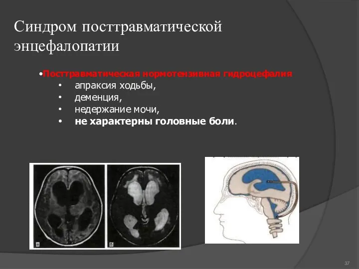 Синдром посттравматической энцефалопатии •Посттравматическая нормотензивная гидроцефалия апраксия ходьбы, деменция, недержание мочи, не характерны головные боли.