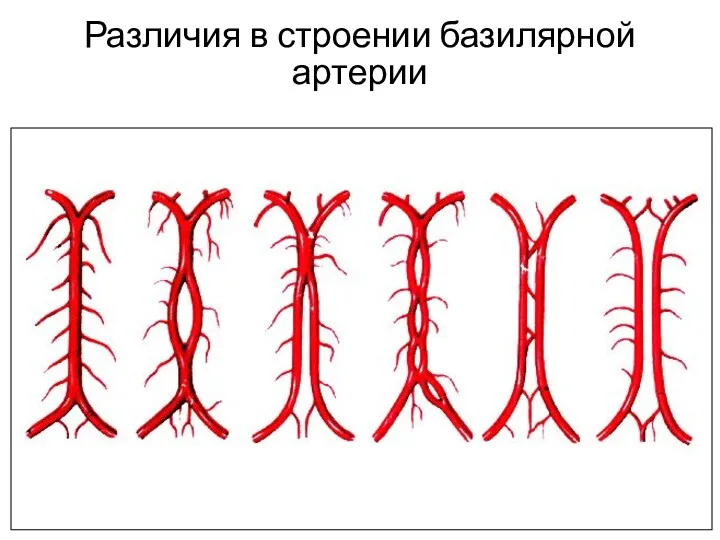 Различия в строении базилярной артерии