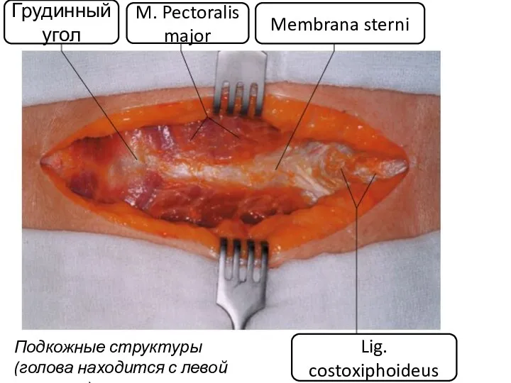 Грудинный угол M. Pectoralis major Lig. costoxiphoideus Membrana sterni Подкожные структуры (голова находится с левой стороны)