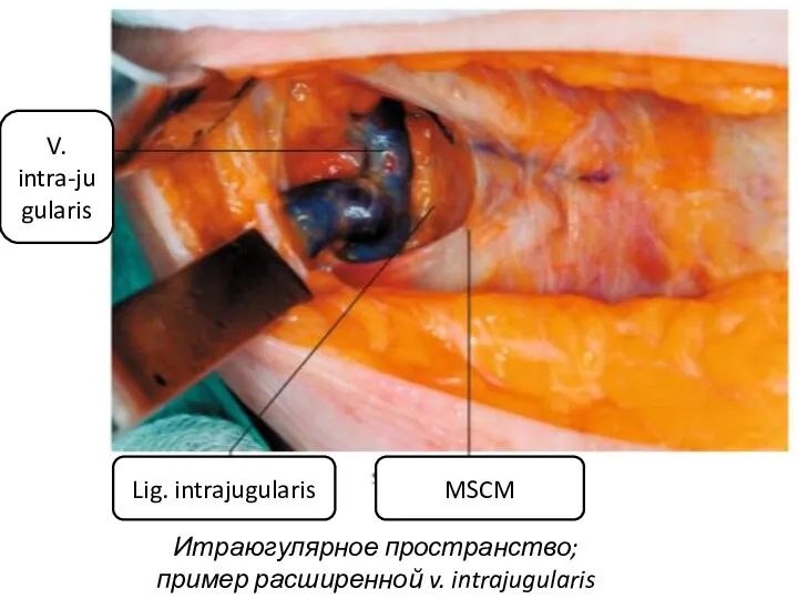 MSCM Lig. intrajugularis V. intra-jugularis Итраюгулярное пространство; пример расширенной v. intrajugularis