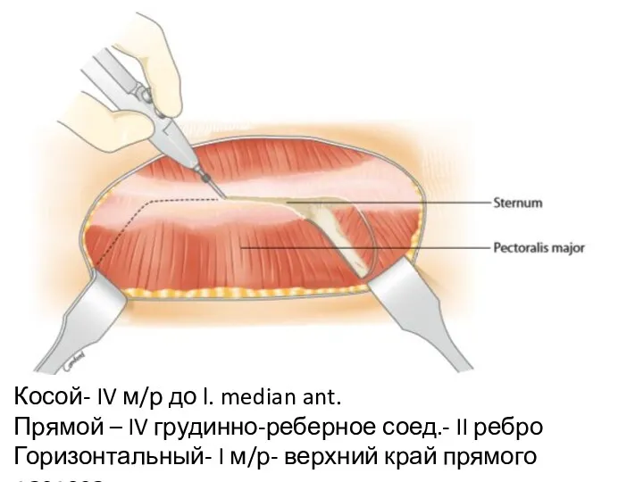 Косой- IV м/р до l. median ant. Прямой – IV