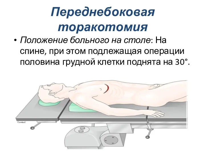 Переднебоковая торакотомия Положение больного на столе: На спине, при этом