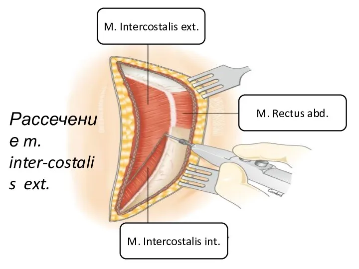 M. Intercostalis int. M. Rectus abd. M. Intercostalis ext. Рассечение m. inter-costalis ext.