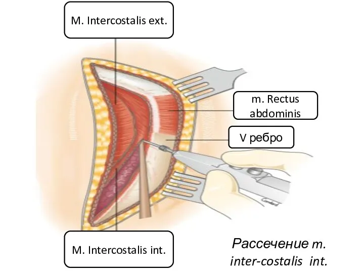 M. Intercostalis ext. M. Intercostalis int. m. Rectus abdominis V ребро Рассечение m. inter-costalis int.