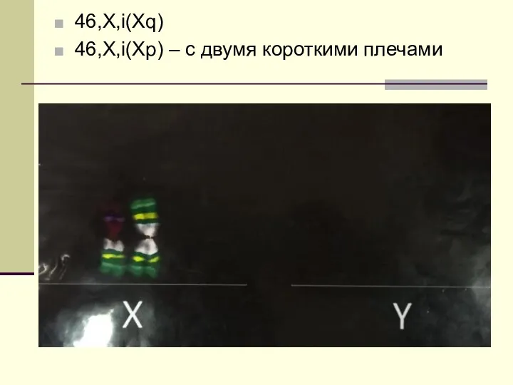 46,X,i(Xq) 46,X,i(Xp) – с двумя короткими плечами