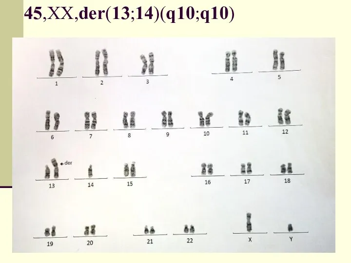 45,ХХ,der(13;14)(q10;q10)