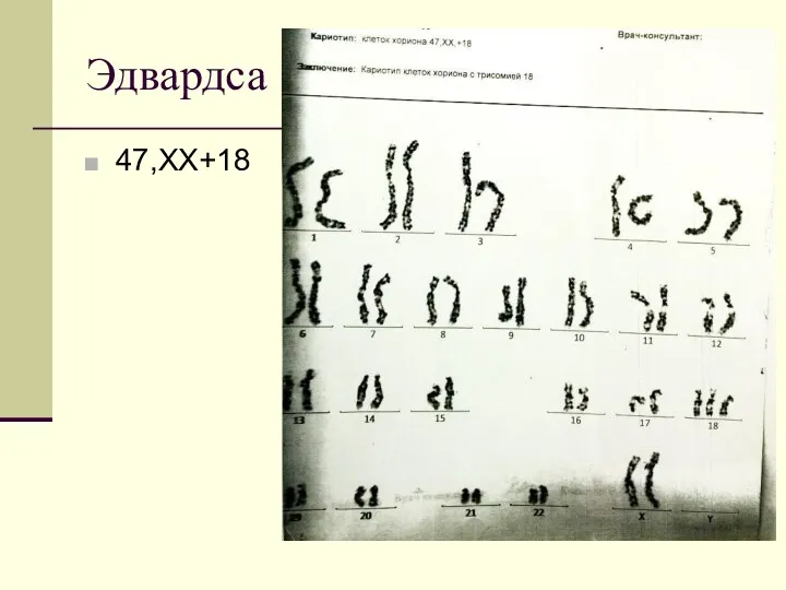 Эдвардса 47,XX+18