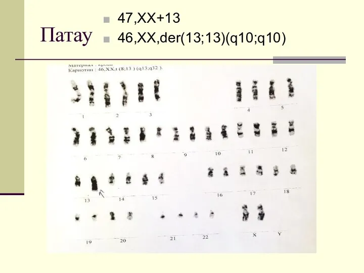 Патау 47,XX+13 46,XX,der(13;13)(q10;q10)