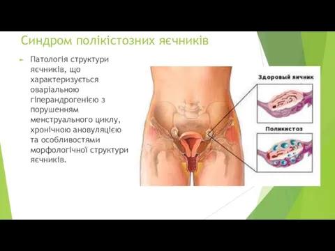 Синдром полікістозних яєчників Патологія структури яєчників, що характеризується оваріальною гіперандрогенією з порушенням менструального