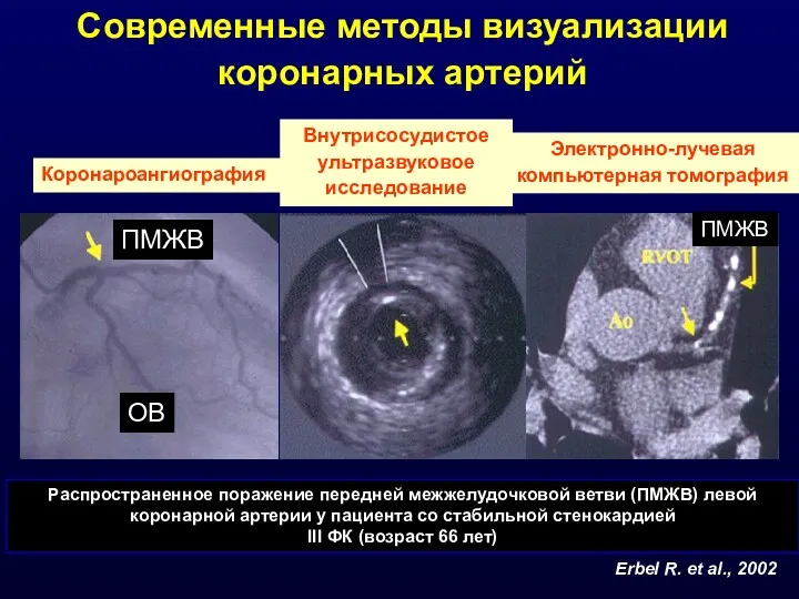 ПМЖВ ОВ ПМЖВ Современные методы визуализации коронарных артерий Erbel R. et al., 2002