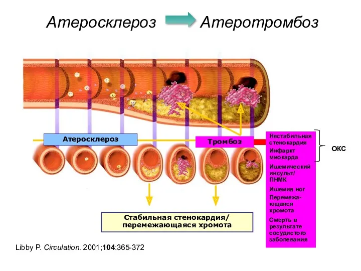 Атеросклероз Атеротромбоз Libby P. Circulation. 2001;104:365-372 Атеросклероз Стабильная стенокардия/ перемежающаяся хромота Тромбоз