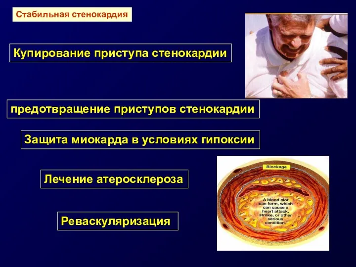 Купирование приступа стенокардии предотвращение приступов стенокардии Защита миокарда в условиях гипоксии Лечение атеросклероза Реваскуляризация Стабильная стенокардия