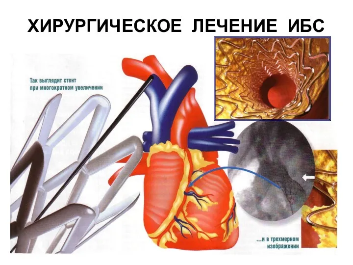 ХИРУРГИЧЕСКОЕ ЛЕЧЕНИЕ ИБС