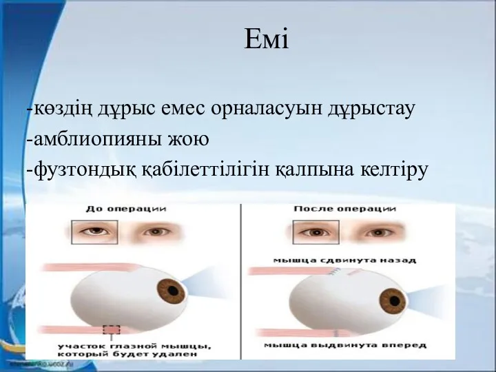 Емі -көздің дұрыс емес орналасуын дұрыстау -амблиопияны жою -фузтондық қабілеттілігін қалпына келтіру