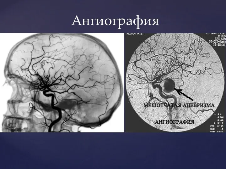 Ангиография