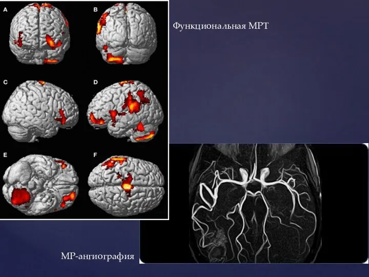 Функциональная МРТ МР-ангиография