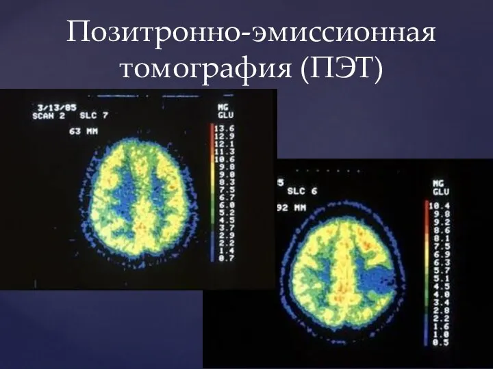 Позитронно-эмиссионная томография (ПЭТ)