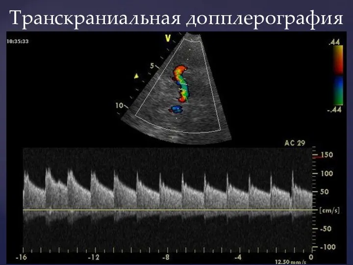 Транскраниальная допплерография