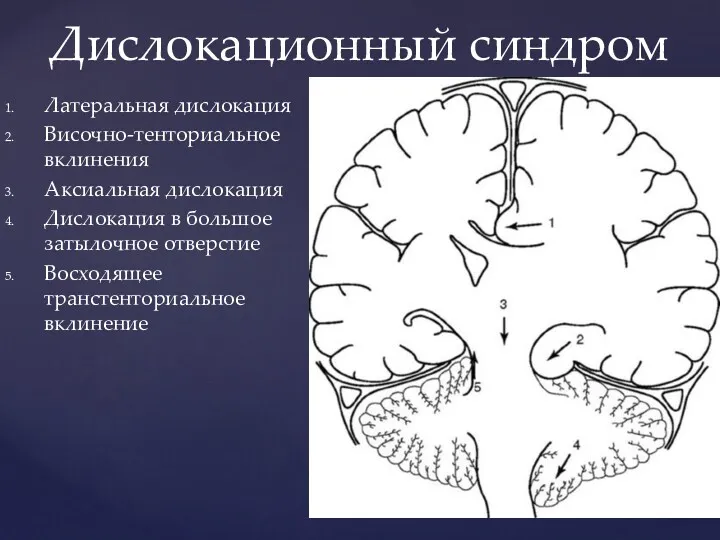 Латеральная дислокация Височно-тенториальное вклинения Аксиальная дислокация Дислокация в большое затылочное отверстие Восходящее транстенториальное вклинение Дислокационный синдром