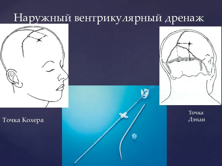 Точка Кохера Наружный вентрикулярный дренаж Точка Дэнди