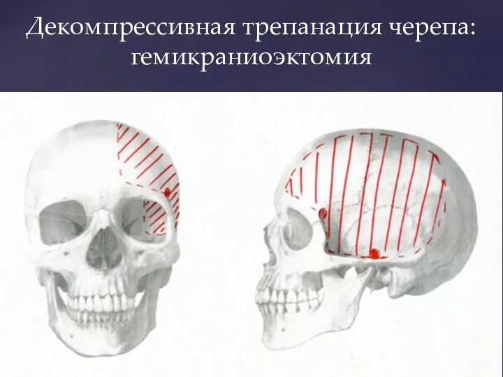 Декомпрессивная трепанация черепа: гемикраниоэктомия