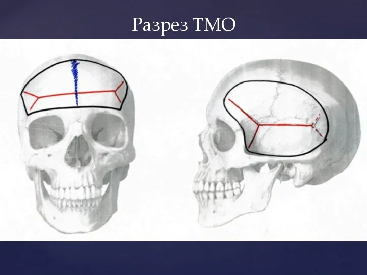 Разрез ТМО