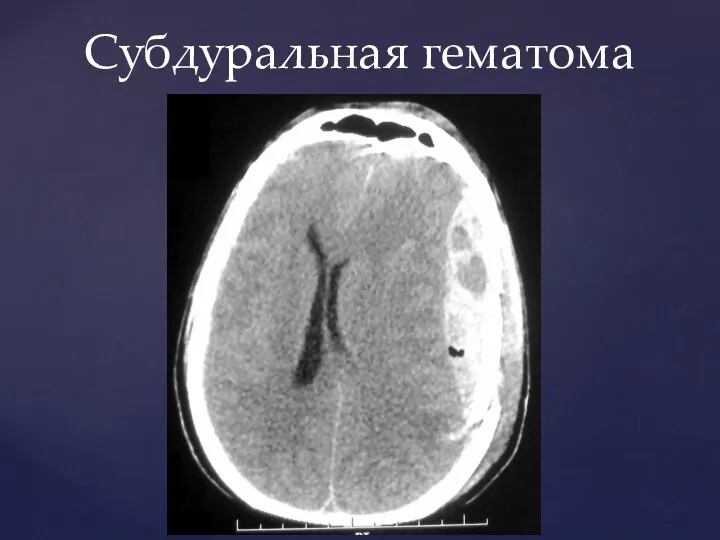 Субдуральная гематома