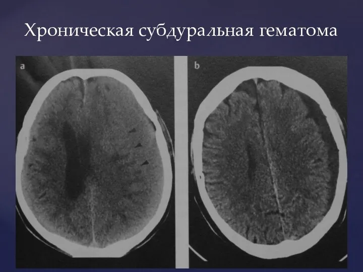 Хроническая субдуральная гематома