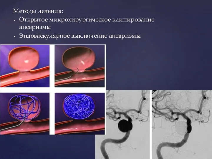 Методы лечения: Открытое микрохирургическое клипирование аневризмы Эндоваскулярное выключение аневризмы