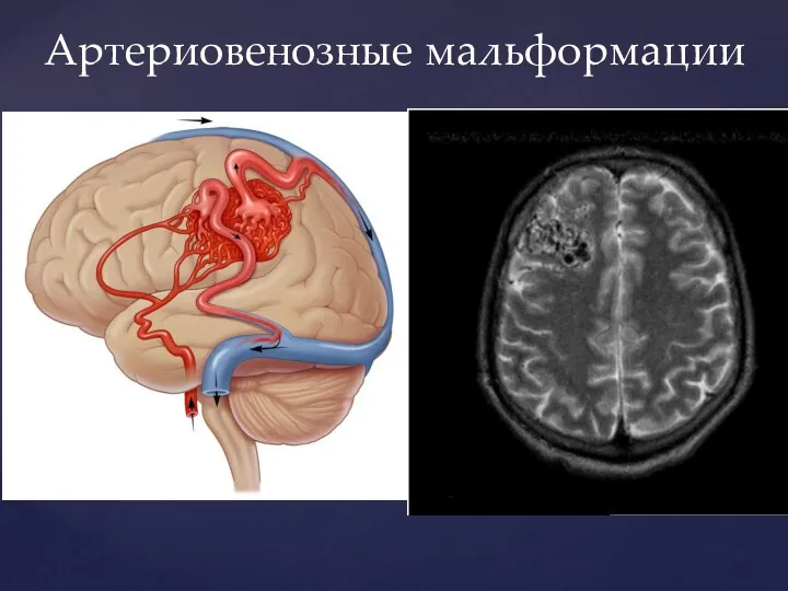 Артериовенозные мальформации