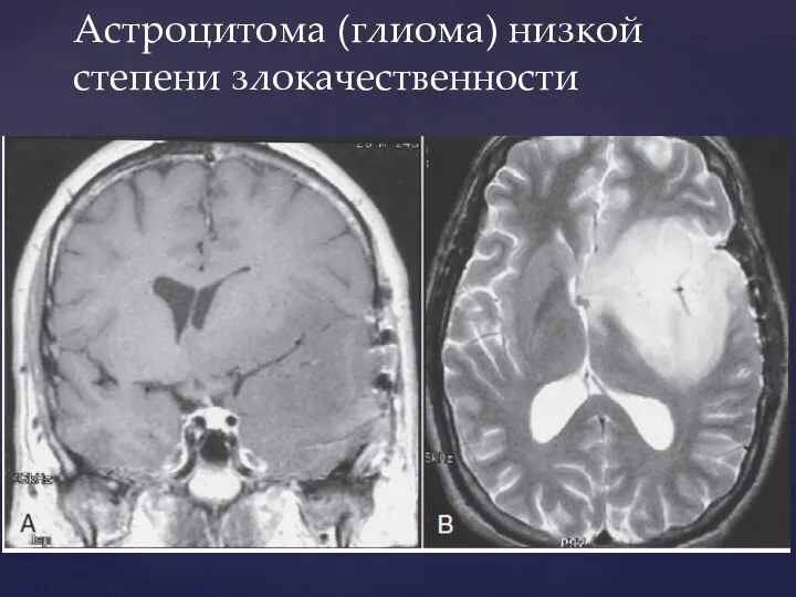 Астроцитома (глиома) низкой степени злокачественности