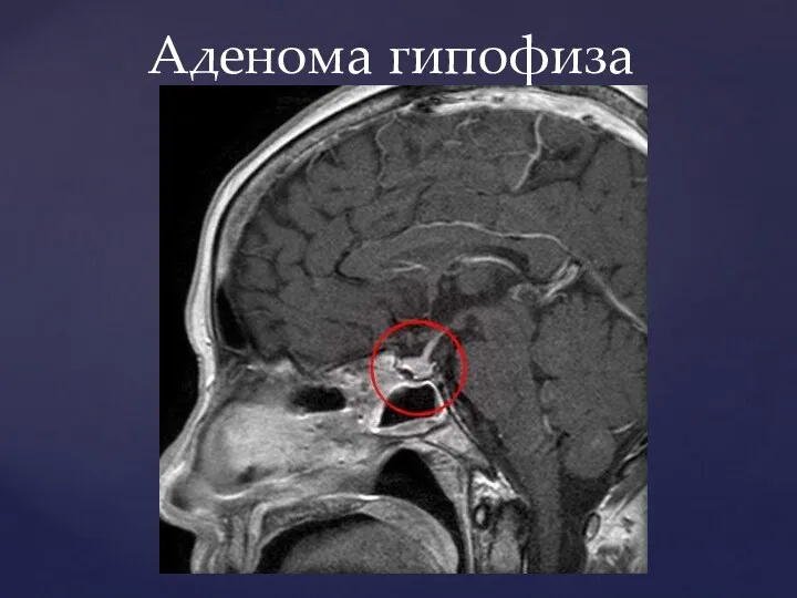 Аденома гипофиза