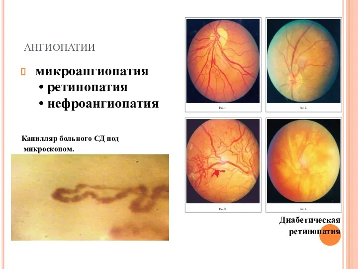 ангиопатии микроангиопатия • ретинопатия • нефроангиопатия Капилляр больного СД под микроскопом. ретинопатия Диабетическая ретинопатия