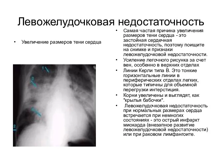 Левожелудочковая недостаточность Увеличение размеров тени сердца Самая частая причина увеличения