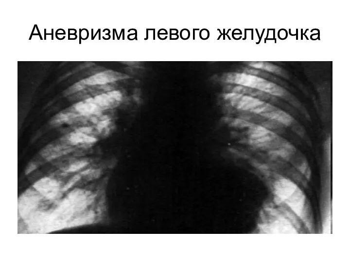 Аневризма левого желудочка