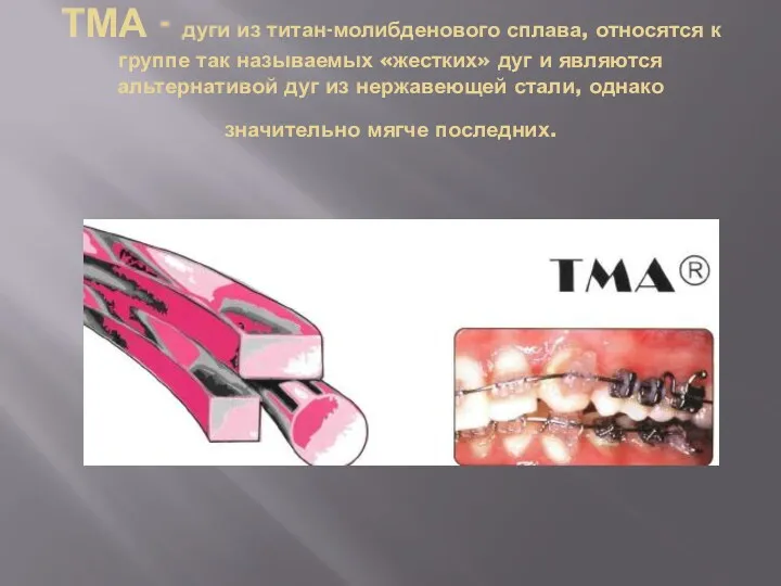 ТМА - дуги из титан-молибденового сплава, относятся к группе так