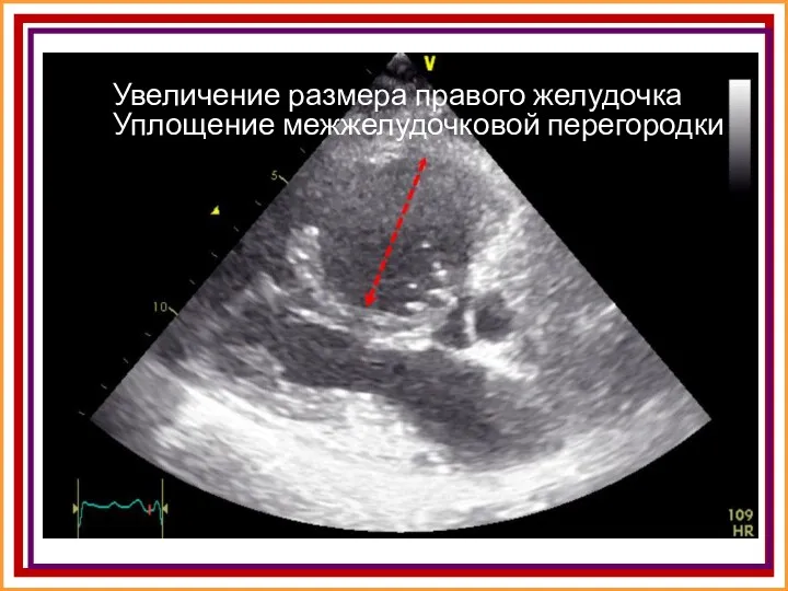 Увеличение размера правого желудочка Уплощение межжелудочковой перегородки