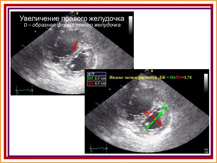 Увеличение правого желудочка D – образная форма левого желудочка