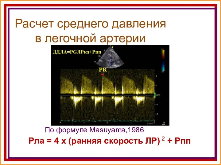 Расчет среднего давления в легочной артерии По формуле Masuyama,1986 Рла