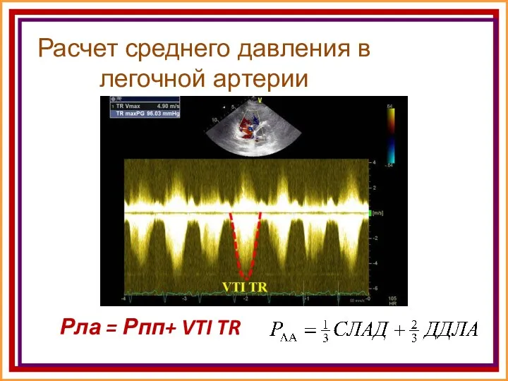 Расчет среднего давления в легочной артерии Рла = Рпп+ VTI TR