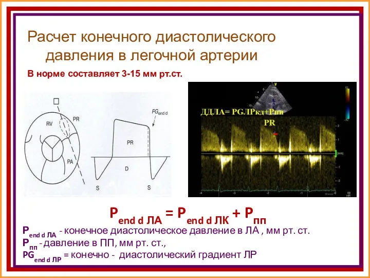 Расчет конечного диастолического давления в легочной артерии Pend d ЛА