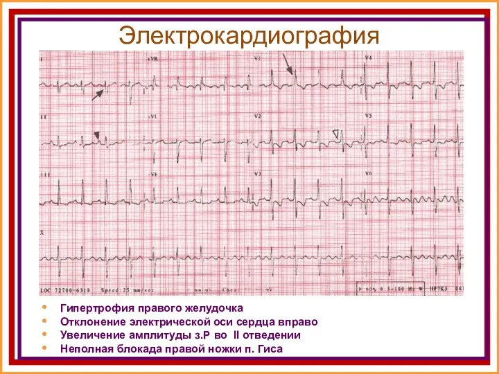 Электрокардиография Гипертрофия правого желудочка Отклонение электрической оси сердца вправо Увеличение