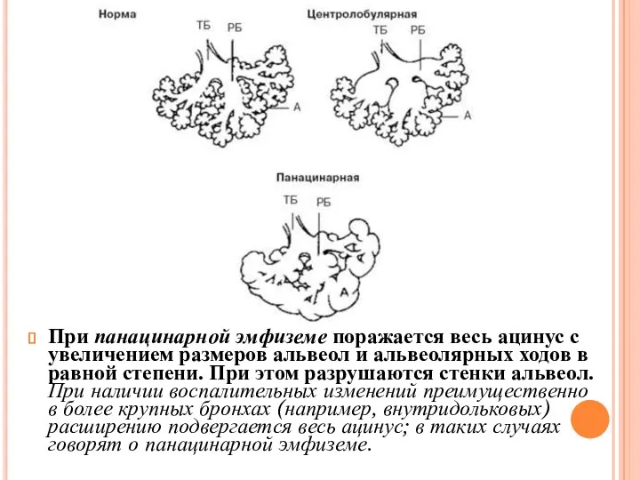 При панацинарной эмфиземе поражается весь ацинус с увеличением размеров альвеол