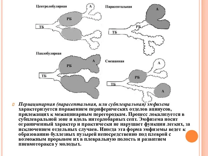 Периацинарная (парасептальная, или субплевральная) эмфи­зема характеризуется поражением периферических отделов ацинусов,