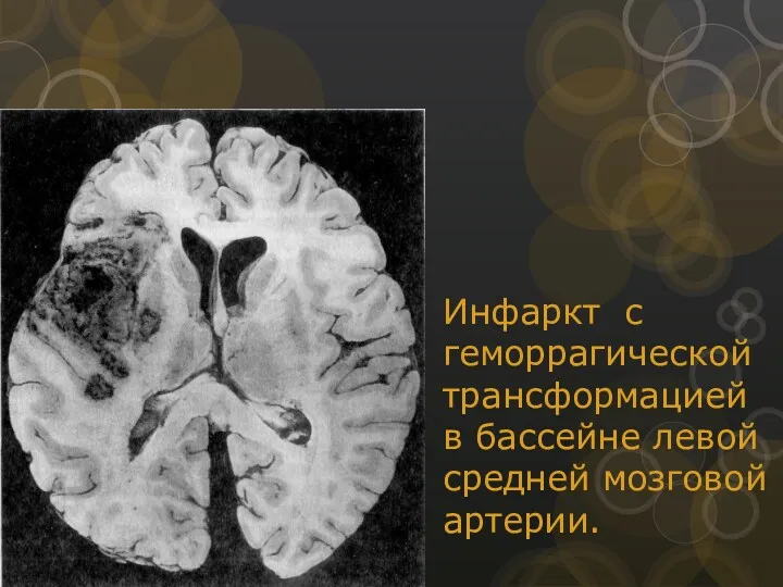 Инфаркт с геморрагической трансформацией в бассейне левой средней мозговой артерии.