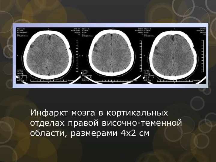 Инфаркт мозга в кортикальных отделах правой височно-теменной области, размерами 4х2 см