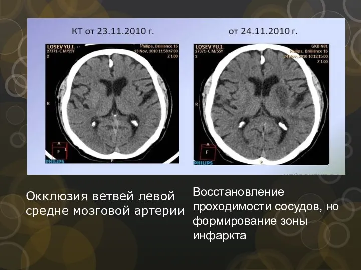 Окклюзия ветвей левой средне мозговой артерии Восстановление проходимости сосудов, но формирование зоны инфаркта